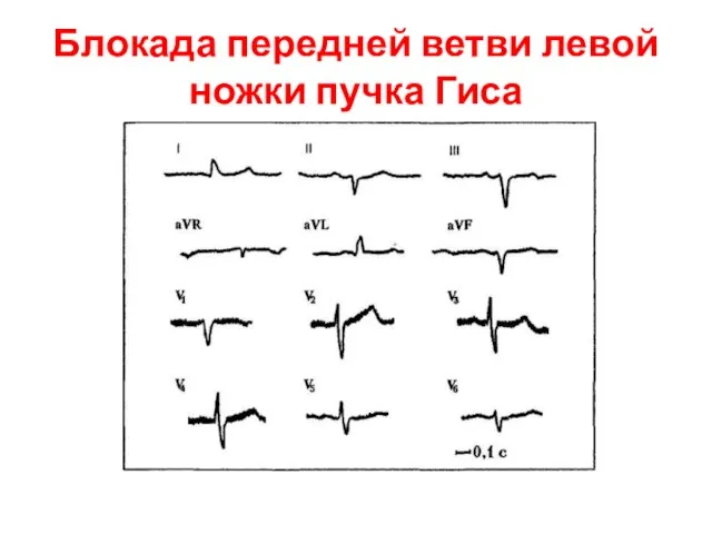 Блокада передней ветви левой ножки пучка Гиса