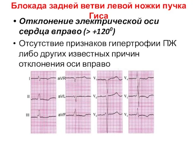 Блокада задней ветви левой ножки пучка Гиса Отклонение электрической оси сердца