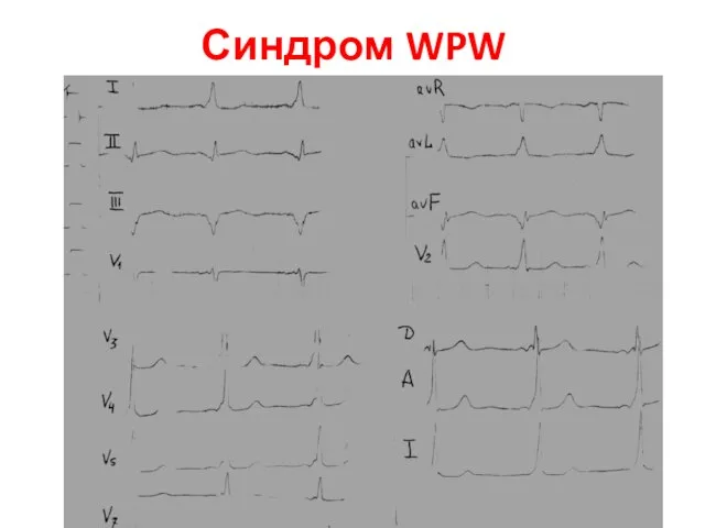 Синдром WPW