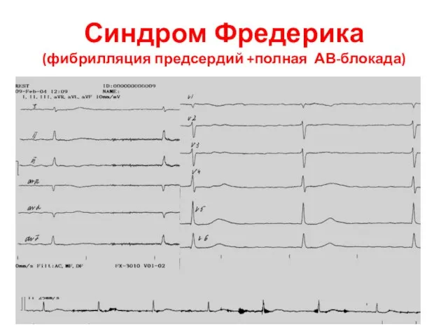 Синдром Фредерика (фибрилляция предсердий +полная АВ-блокада)