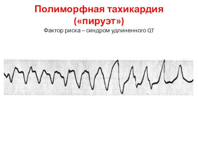 Полиморфная тахикардия («пируэт») Фактор риска – синдром удлиненного QT