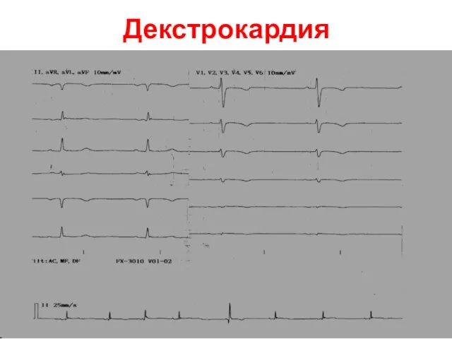 Декстрокардия