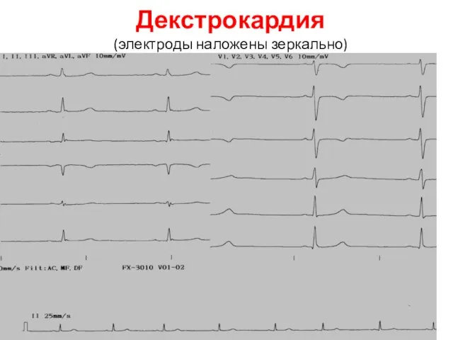 Декстрокардия (электроды наложены зеркально)