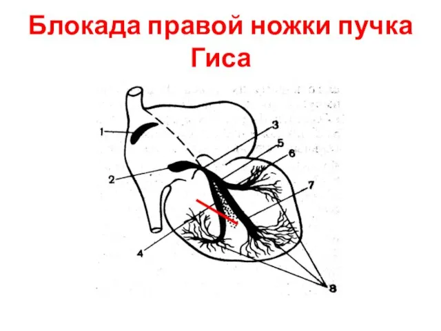 Блокада правой ножки пучка Гиса