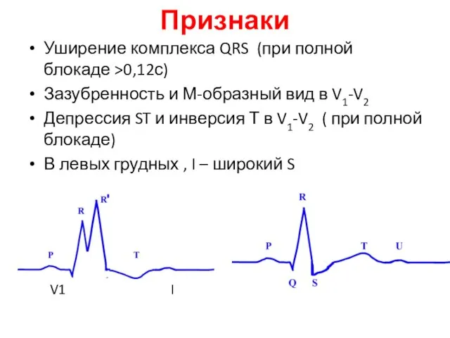 Признаки Уширение комплекса QRS (при полной блокаде >0,12с) Зазубренность и М-образный