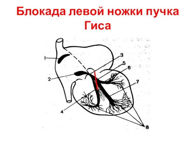 Блокада левой ножки пучка Гиса