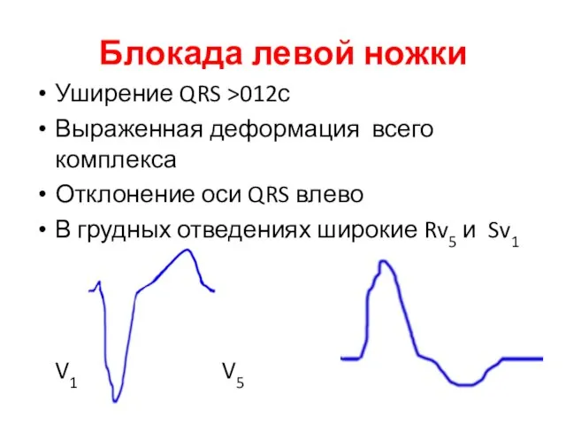 Блокада левой ножки Уширение QRS >012с Выраженная деформация всего комплекса Отклонение