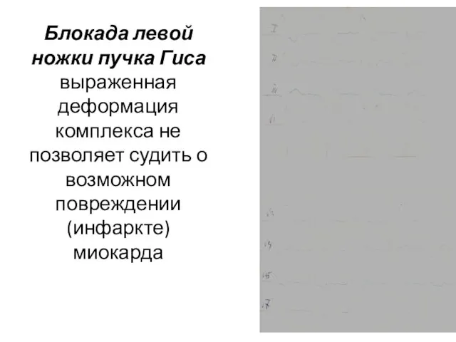 Блокада левой ножки пучка Гиса выраженная деформация комплекса не позволяет судить о возможном повреждении (инфаркте) миокарда