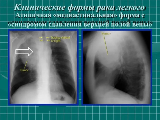 Клинические формы рака легкого Атипичная «медиастинальная» форма с «синдромом сдавления верхней полой вены»