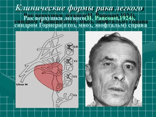 Клинические формы рака легкого Рак верхушки легкого(H. Pancoast,1924), синдром Горнера(птоз, миоз, энофтальм) справа