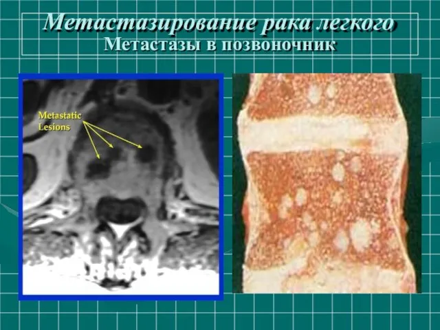 Метастазирование рака легкого Метастазы в позвоночник