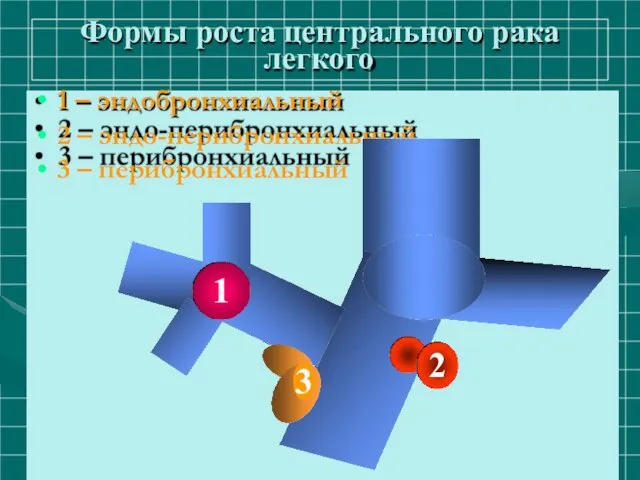 Формы роста центрального рака легкого 1 – эндобронхиальный 2 – эндо-перибронхиальный