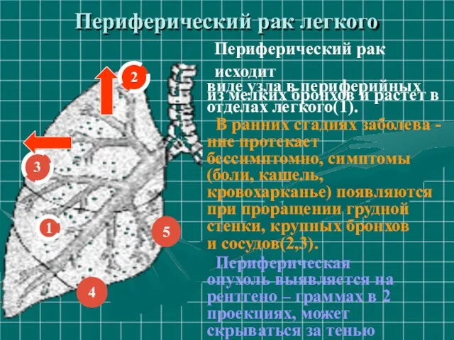 Периферический рак легкого 1 3 5 2 4 Периферический рак исходит