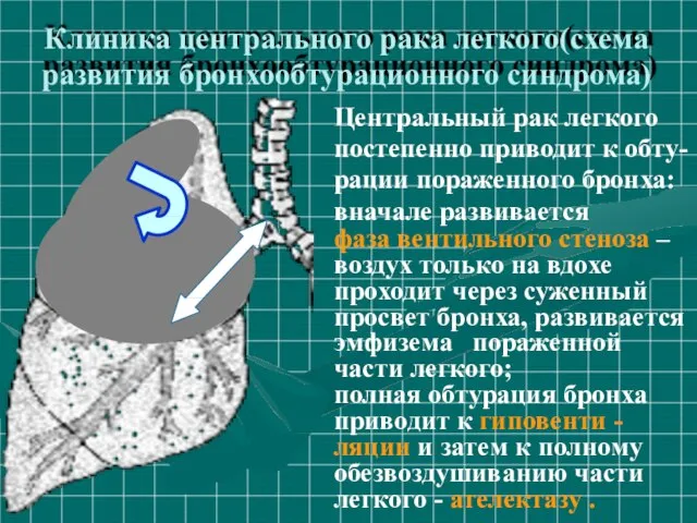 Клиника центрального рака легкого(схема развития бронхообтурационного синдрома) Центральный рак легкого постепенно