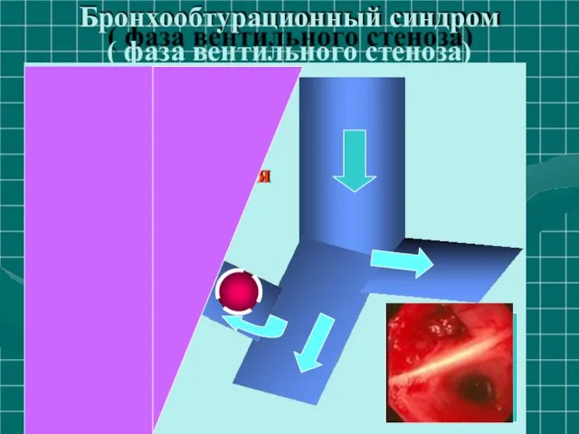 Бронхообтурационный синдром ( фаза вентильного стеноза) Вентильн одышка, к кровохарк субфебрил