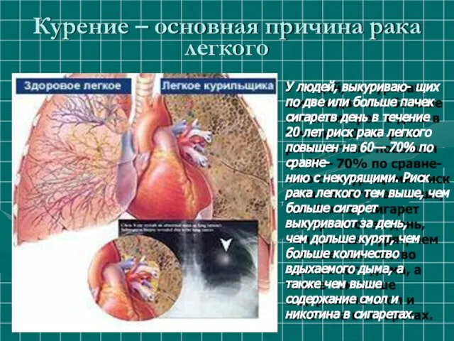 Курение – основная причина рака легкого У людей, выкуриваю- щих по