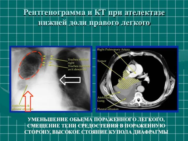 Рентгенограмма и КТ при ателектазе нижней доли правого легкого УМЕНЬШЕНИЕ ОБЬЕМА