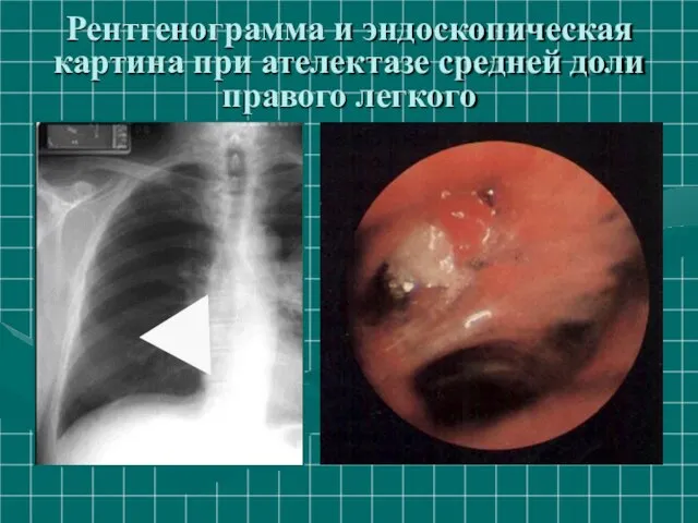 Рентгенограмма и эндоскопическая картина при ателектазе средней доли правого легкого