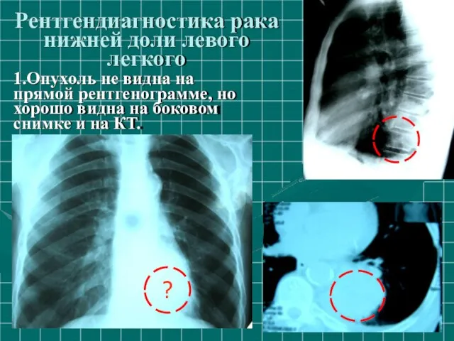 Рентгендиагностика рака нижней доли левого легкого 1.Опухoль не видна на прямой