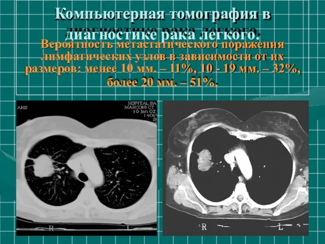 Компьютерная томография в диагностике рака легкого. Вероятность метастатического поражения лимфатических узлов