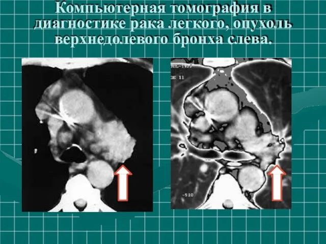 Компьютерная томография в диагностике рака легкого, опухоль верхнедолевого бронха слева.