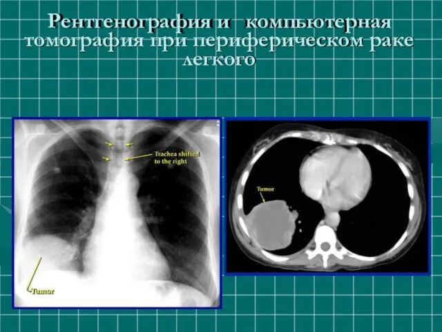 Рентгенография и компьютерная томография при периферическом раке легкого