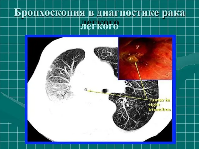 Бронхоскопия в диагностике рака легкого