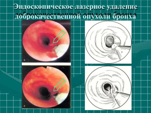 Эндоскопическое лазерное удаление доброкачественной опухоли бронха