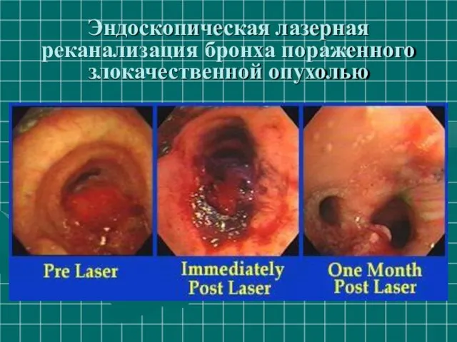 Эндоскопическая лазерная реканализация бронха пораженного злокачественной опухолью