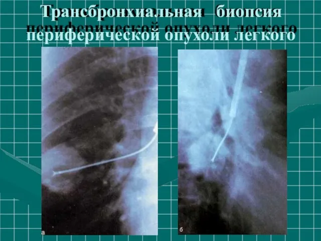 Трансбронхиальная биопсия периферической опухоли легкого