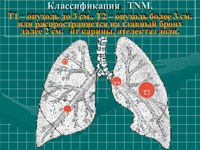 Классификация TNM. Т1 – опухоль до 3 см., Т2 – опухоль