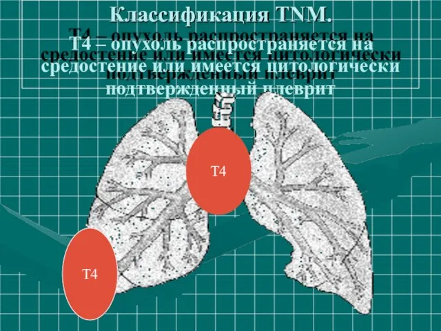 Классификация ТNM. Т4 – опухоль распространяется на средостение или имеется цитологически подтвержденный плеврит Т4 Т4