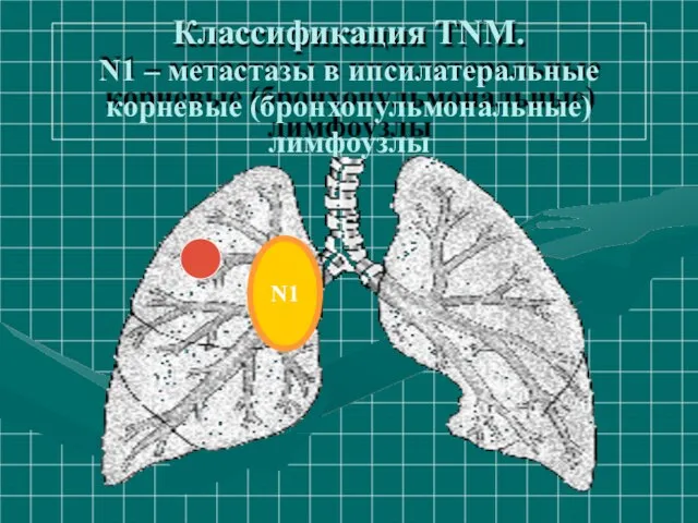 Классификация ТNM. N1 – метастазы в ипсилатеральные корневые (бронхопульмональные) лимфоузлы N1