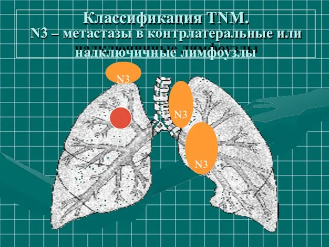 Классификация ТNM. N3 – метастазы в контрлатеральные или надключичные лимфоузлы N3 N3 N3