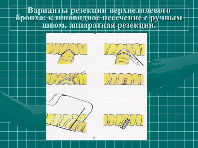 Варианты резекции верхнедолевого бронха: клиновидное иссечение с ручным швом, аппаратная резекция.