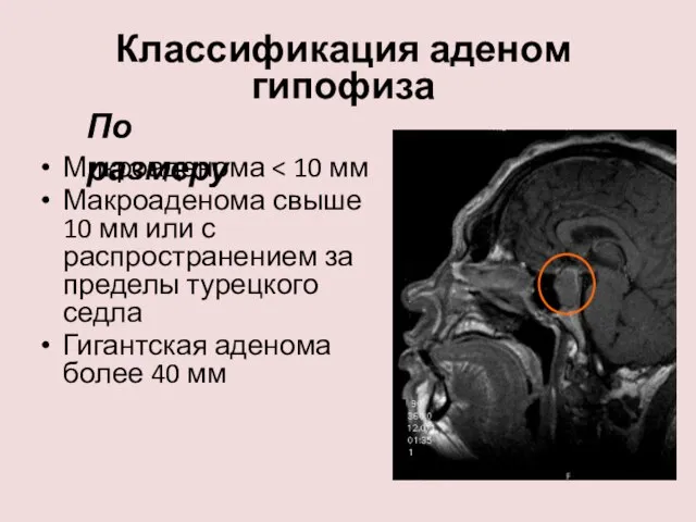 Классификация аденом гипофиза Микроаденома Макроаденома свыше 10 мм или с распространением