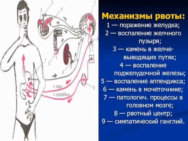 Механизмы рвоты: 1 — поражение желудка; 2 — воспаление желчного пузыря;