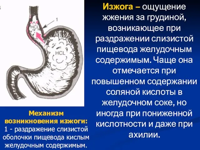 Изжога – ощущение жжения за грудиной, возникающее при раздражении слизистой пищевода