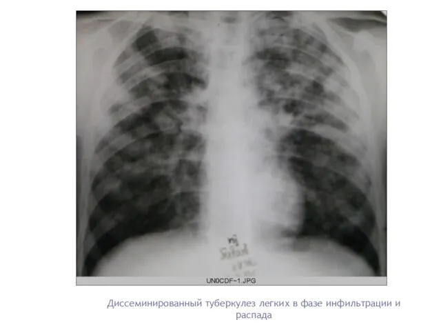 Диссеминированный туберкулез легких в фазе инфильтрации и распада