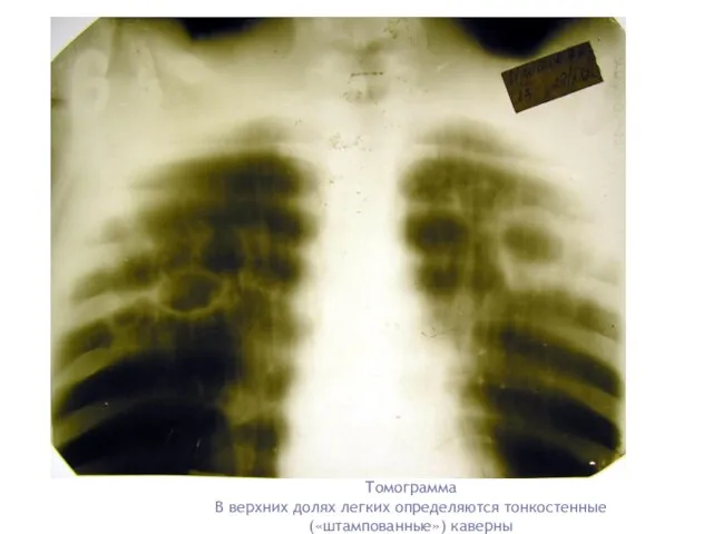 Томограмма В верхних долях легких определяются тонкостенные («штампованные») каверны