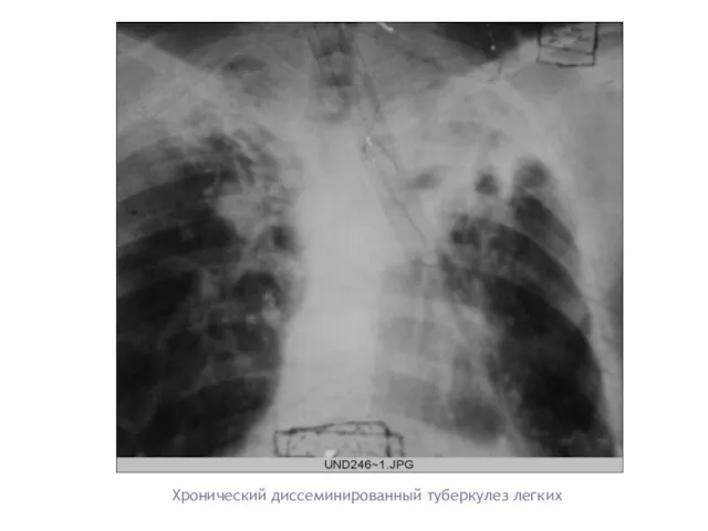 Хронический диссеминированный туберкулез легких