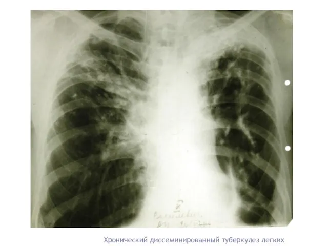 Хронический диссеминированный туберкулез легких