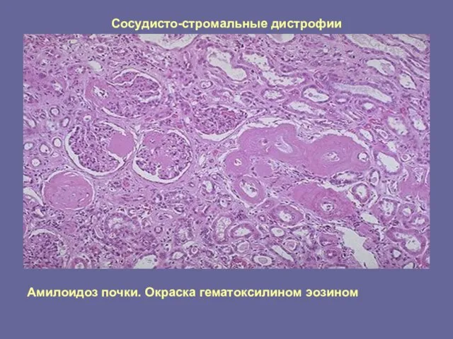 Сосудисто-стромальные дистрофии Амилоидоз почки. Окраска гематоксилином эозином