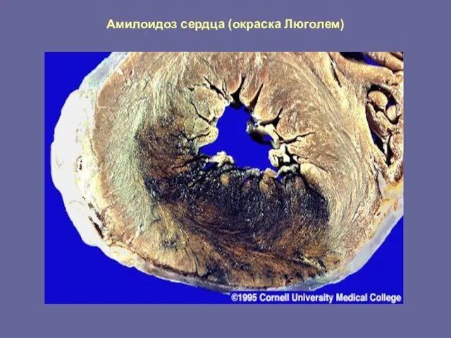 Амилоидоз сердца (окраска Люголем)