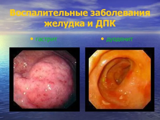 Воспалительные заболевания желудка и ДПК гастрит дуоденит