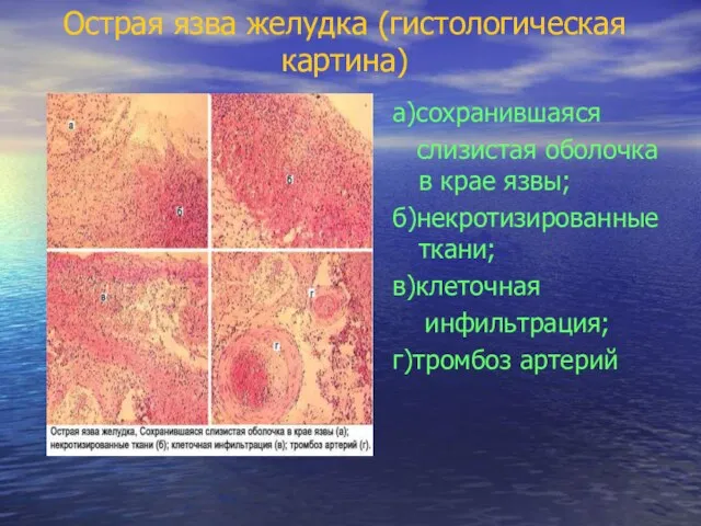 Острая язва желудка (гистологическая картина) а)сохранившаяся слизистая оболочка в крае язвы;