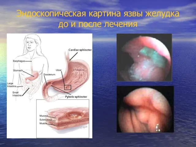 Эндоскопическая картина язвы желудка до и после лечения