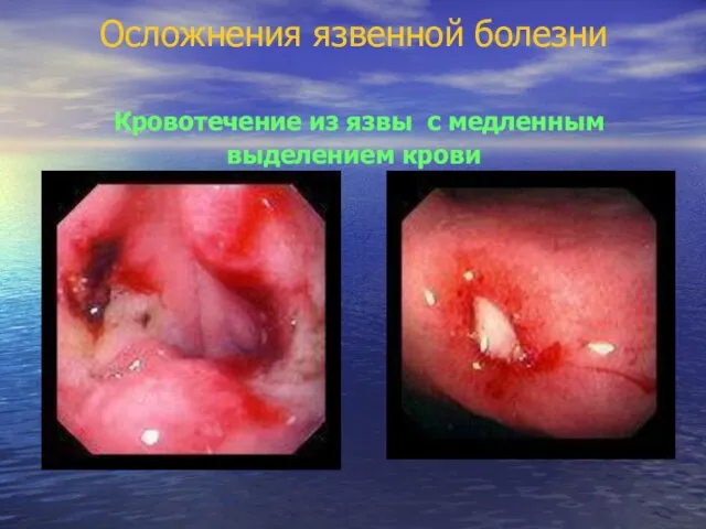 Осложнения язвенной болезни Кровотечение из язвы с медленным выделением крови