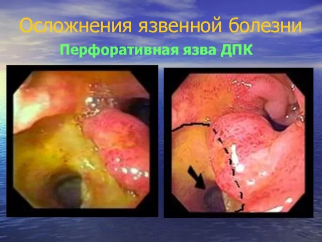 Осложнения язвенной болезни Перфоративная язва ДПК