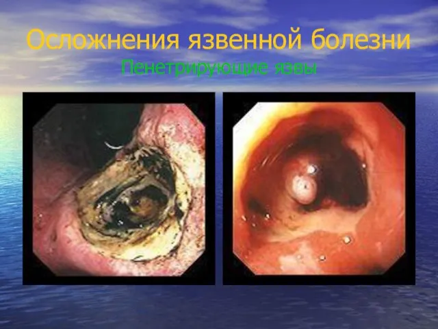 Осложнения язвенной болезни Пенетрирующие язвы